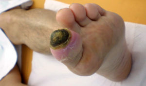 1200px-Diabetic_foot_syndrome2